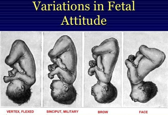 ATTITUDE OF THE FETAL HEAD (1)