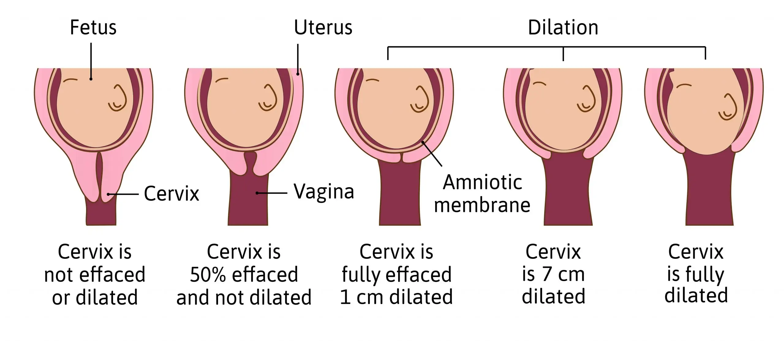 Cervical Dilatation in Labour