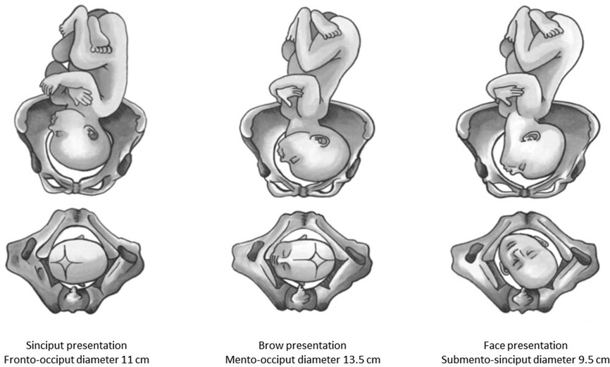 Fetal Lie, Presentation, and Attitude Diagram