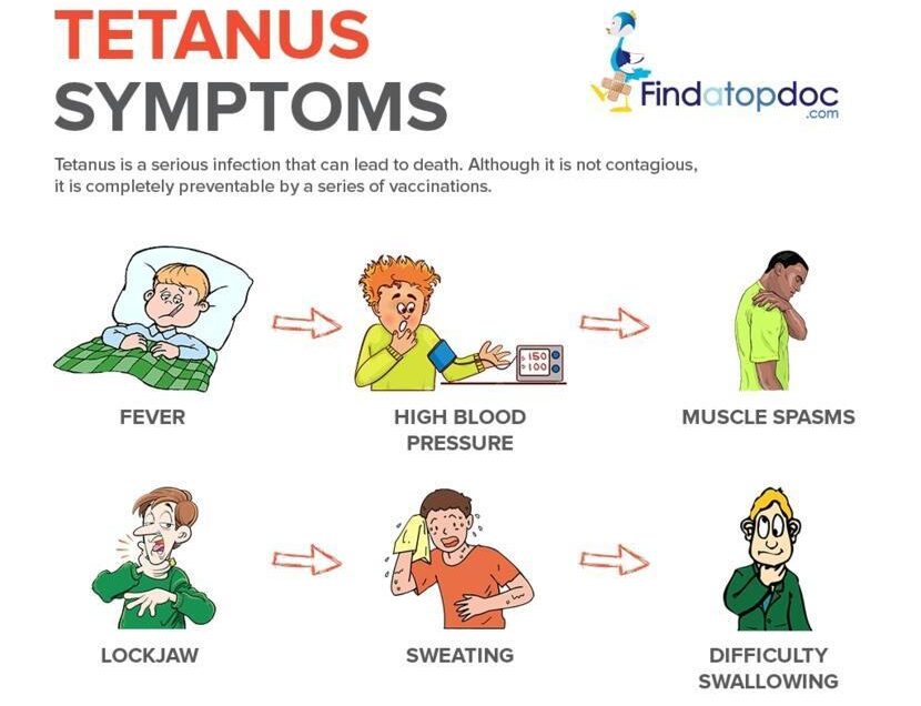 Clinical Features of Tetanus: