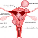 FIBROIDS (FIBROMYOMAS)