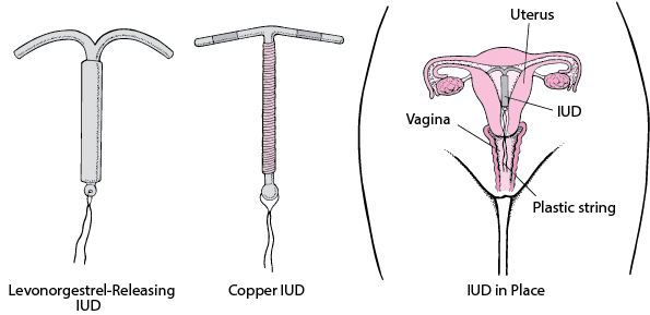 artificial Intra-Uterine Contraceptive Device (IUCDs)