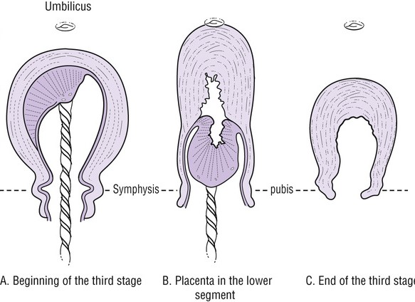 Normal third stage of labour