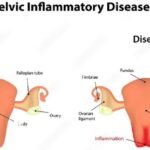 PELVIC INFLAMMATORY DISEASES (PID)