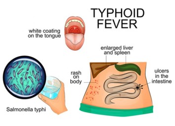 Typhoid Fever (Enteric Fever)