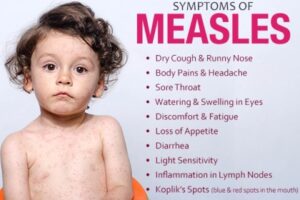 Measles - Midwives Revision