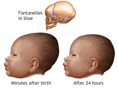 Types of Molding fetal head moulding