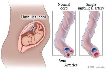 Abnormal Number of Blood Vessels MIDWIVES REVISION