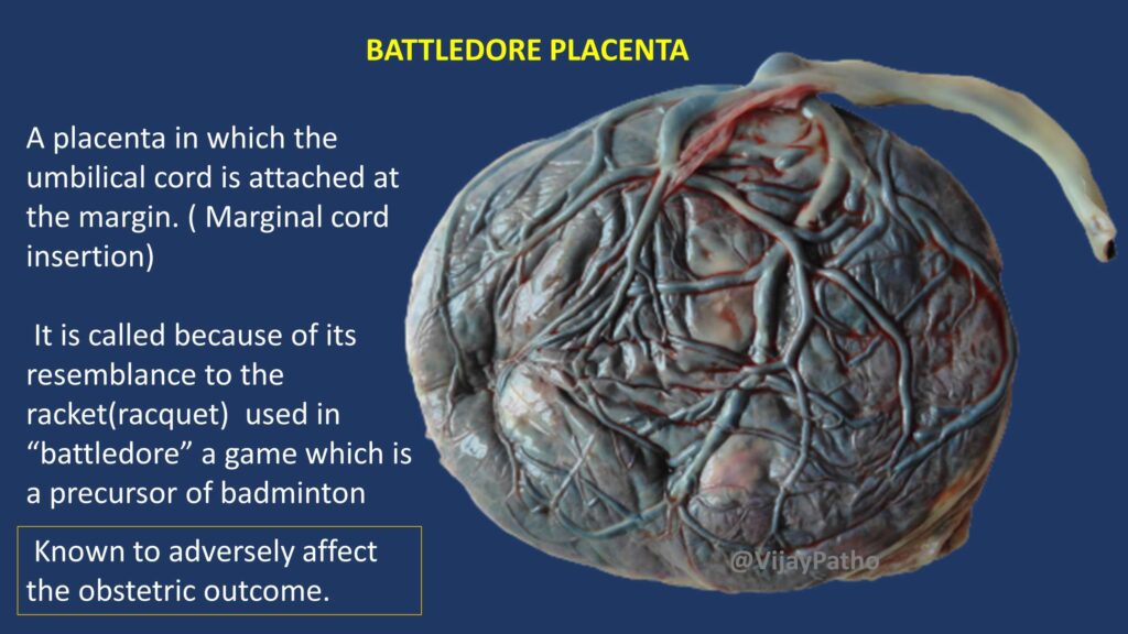 Battledore Insertion MIDWIVES REVISION (1)