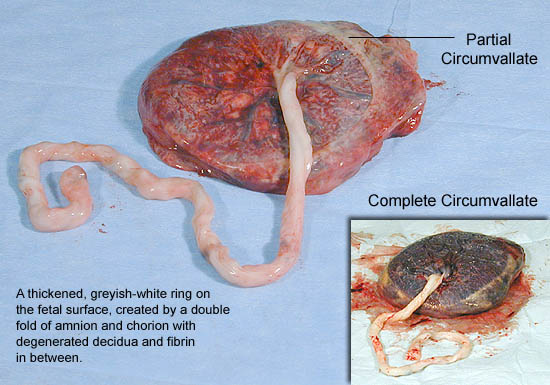 Circumvallate Placenta midwives revision