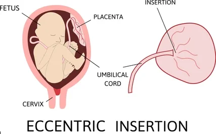 Eccentric Lateral Insertion MIDWIVES REVISION