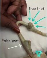 False Knots ABNORMALITES TRUE KNOT