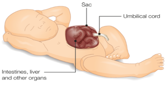 Omphalocele EXOMPOLOS MIDWIVES REVISION