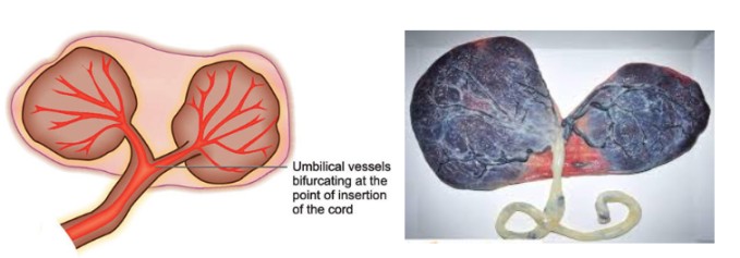 bipartite placenta midwives revision