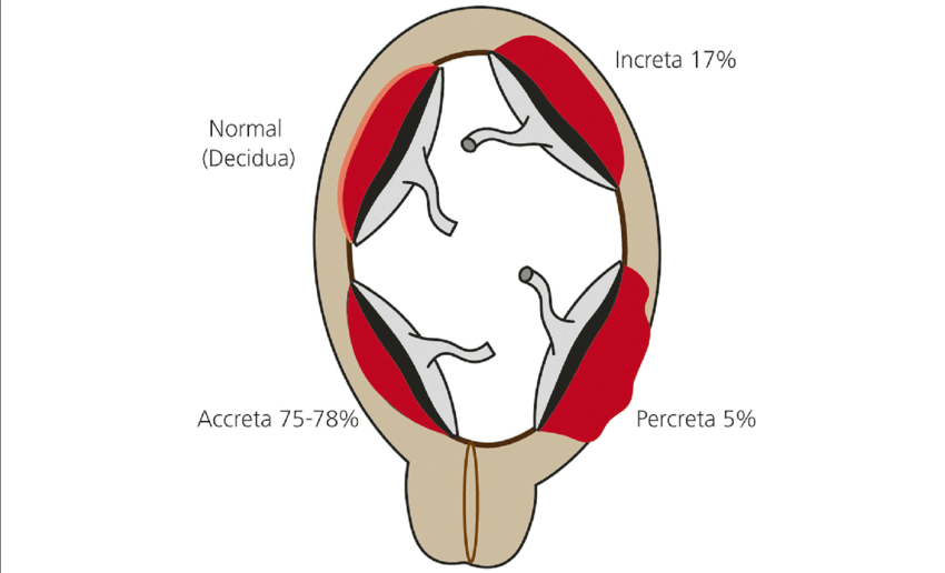 placenta accreta increta percretaplacenta accreta increta percreta midwives revision