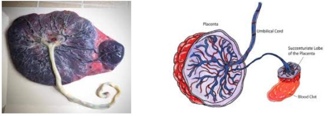 succenturiate placenta midwives revision