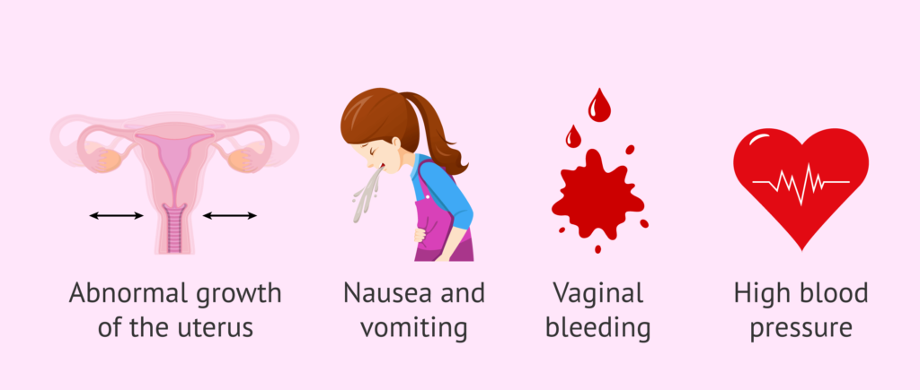 Clinical Features Hydatidiform mole