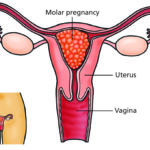 HYDATIDIFORM MOLE (VESICULAR) (1)