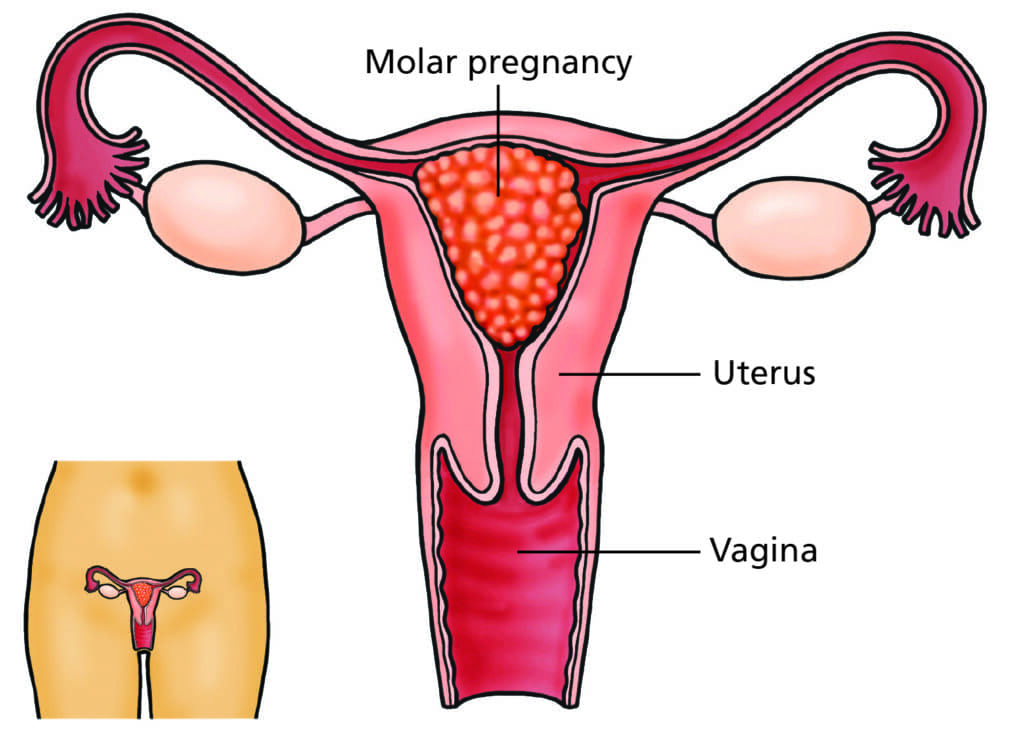 HYDATIDIFORM MOLE (VESICULAR) (1)