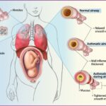 ASTHMA IN PREGNANCY