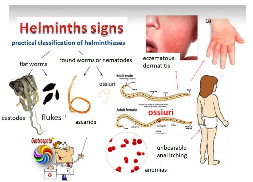 Clinical Features Helminthic diseases (Intestinal worms)