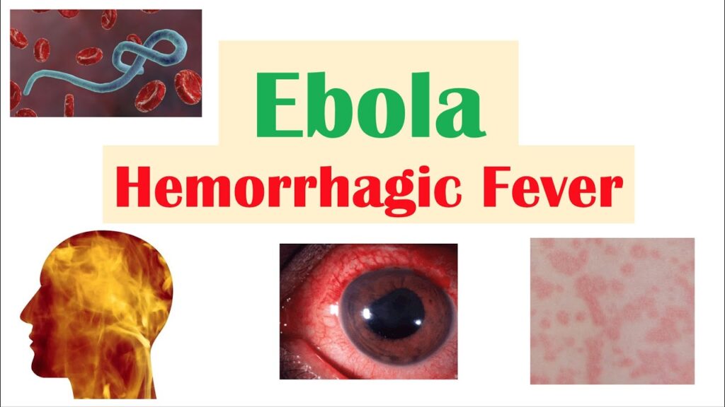 EBOLA: HAEMORRHAGIC FEVERS