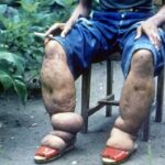 Elephantiasis (Bancroftian Filariasis)