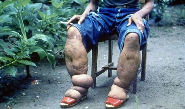 Elephantiasis (Bancroftian Filariasis)