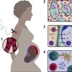 MALARIA IN PREGNANCY