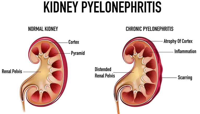 Pyelonephritis in Pregnancy