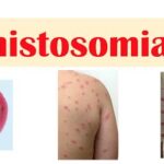 Schistosomiasis