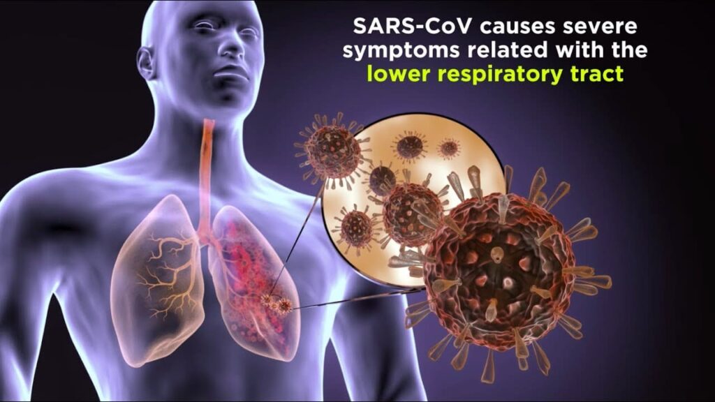 Severe Acute Respiratory Syndrome (SARS)