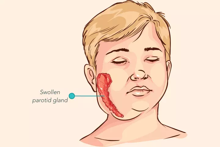 mumps (Parotitis)